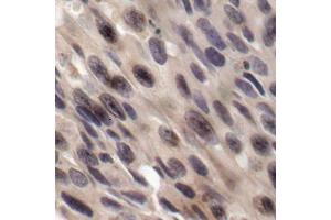 Immunohistochemistry of paraffin-embedded human breast carcinoma, using Phospho-EIF4EBP1-T36 antibody (ABIN2987995). (eIF4EBP1 anticorps  (pThr36))