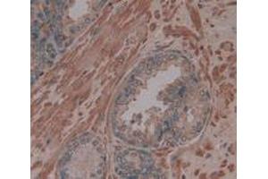 IHC-P analysis of Human Prostate Gland Tissue, with DAB staining. (Procollagen Type I Propeptide anticorps  (N-Term))