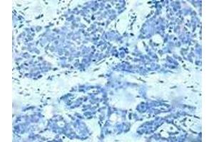 Immunohistochemistry of paraffin-embedded human thyroid cancer (treated with synthetic peptide) using ABIN7190935 at dilution of 1:20