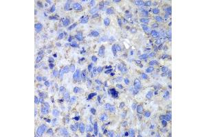 Immunohistochemistry of paraffin-embedded human lung cancer using Casp7 antibody at dilution of 1:100 (400x lens).