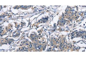 Immunohistochemistry of paraffin-embedded Human gastric cancer using CAPZA2 Polyclonal Antibody at dilution of 1:30 (CAPZA2 anticorps)
