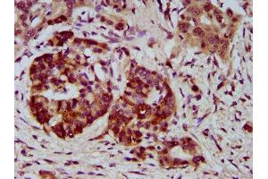 IHC image of ABIN7169579 diluted at 1:400 and staining in paraffin-embedded human pancreatic cancer performed on a Leica BondTM system.