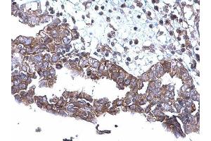 IHC-P Image SQSTM1 antibody [N3C1], Internal detects SQSTM1 protein at cytoplasm on human ovarian carcinoma by immunohistochemical analysis. (SQSTM1 anticorps)