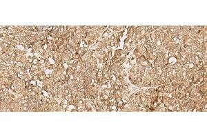 Immunohistochemistry of paraffin-embedded Human ovarian cancer tissue using SNAPC5 Polyclonal Antibody at dilution of 1:25(x200) (SNAPC5 anticorps)