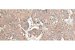 Immunohistochemistry of paraffin-embedded Human prost at e cancer tissue using KRT73 Polyclonal Antibody at dilution of 1:55(x200) (KRT73 anticorps)