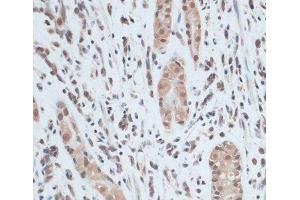 Immunohistochemistry of paraffin-embedded Human gastric cancer using ZNF416 Polyclonal Antibody at dilution of 1:100 (40x lens). (ZNF416 anticorps)