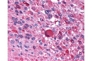 Anti-AVPR1B antibody IHC of human Brain, Glioblastoma.