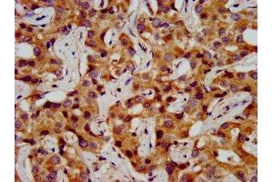 IHC image of ABIN7155063 diluted at 1:200 and staining in paraffin-embedded human liver cancer performed on a Leica BondTM system. (ONECUT1 anticorps  (AA 192-292))