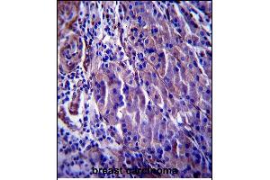 CDKN1A Antibody (C-term) (ABIN657391 and ABIN2846432) immunohistochemistry analysis in formalin fixed and paraffin embedded human breast carcinoma followed by peroxidase conjugation of the secondary antibody and DAB staining. (p21 anticorps  (C-Term))