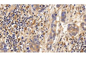 Detection of IL13Ra2 in Human Lymphoma Tissue using Polyclonal Antibody to Interleukin 13 Receptor Alpha 2 (IL13Ra2)