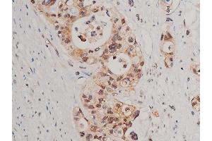 ABIN6267520 at 1/50 staining human colon cancer tissue sections by IHC-P.
