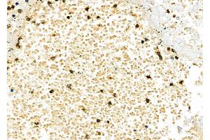 ABIN6262151 and ABIN6277238 at 1/100 staining Human lung cancer and adjacent normal tissues by IHC-P.