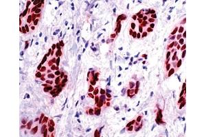 Anti Progesterone Receptor monoclonal antibody - Immunohistochemistry.
