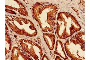 Immunohistochemistry of paraffin-embedded human prostate cancer using ABIN7158066 at dilution of 1:100 (LRRFIP1 anticorps  (AA 1-315))