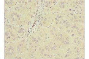 Immunohistochemistry of paraffin-embedded human liver cancer using ABIN7163200 at dilution of 1:100 (INPP5J anticorps  (AA 60-360))