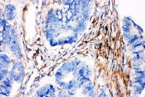 IHC-P: Caveolin-2 antibody testing of human intestinal cancer tissue (Caveolin 2 anticorps  (AA 1-162))