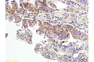 Formalin-fixed and paraffin embedded human ovarian cancer labeled with Anti-HER2 receptor(NT) Polyclonal Antibody, unconjugated (ABIN678068)  at 1: 200 followed by incubation with conjugated secondary antibody and DAB staining (ErbB2/Her2 anticorps  (AA 151-250))