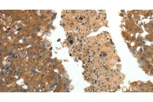 Immunohistochemistry of paraffin-embedded Human breast cancer using CRP Polyclonal Antibody at dilution of 1:80 (CRP anticorps)
