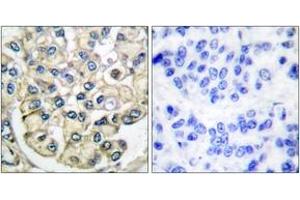 Immunohistochemistry analysis of paraffin-embedded human breast carcinoma tissue, using FGFR2 Antibody.