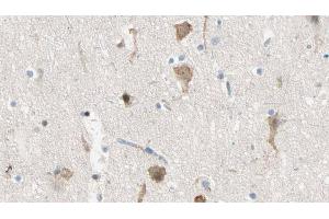 ABIN6274450 at 1/100 staining Human brain cancer tissue by IHC-P. (MADD anticorps  (Internal Region))