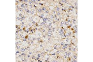Immunohistochemistry of paraffin-embedded human kidney cancer using NFE2L2 antibody at dilution of 1:200 (x400 lens)