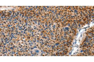 Immunohistochemistry of paraffin-embedded Human liver cancer using AMDHD2 Polyclonal Antibody at dilution of 1:40 (AMDHD2 anticorps)