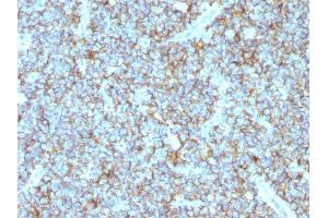 Formalin-fixed, paraffin-embedded human Ewing's sarcoma stained with CD99 Monoclonal Antibody (MIC2/877). (CD99 anticorps)
