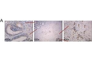 The correlation between XPNPEP2 and metastasis.