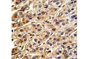 IHC analysis of FFPE human hepatocarcinoma stained with SHP2 antibody