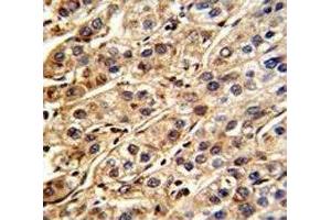 IHC analysis of FFPE human hepatocarcinoma stained with SHP2 antibody (PTPN11 anticorps  (AA 526-551))