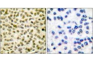 Immunohistochemistry analysis of paraffin-embedded human breast carcinoma, using Myc (Phospho-Ser62) Antibody. (c-MYC anticorps  (pSer62))