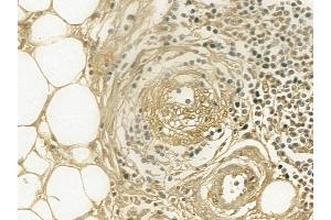 Cytokeratin 2e Mouse Monoclonal Antibody at 1/100 staining human pancreatic cancer and adjacent non-tumor tissue by IHC-P. (Keratin 2 anticorps  (N-Term))