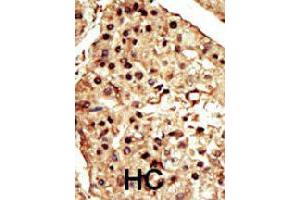 Formalin-fixed and paraffin-embedded human hepatocellular carcinoma tissue reacted with TRPM7 polyclonal antibody  , which was peroxidase-conjugated to the secondary antibody, followed by DAB staining. (TRPM7 anticorps  (C-Term))