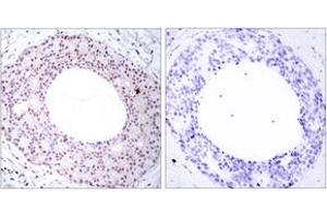 Immunohistochemistry analysis of paraffin-embedded human breast carcinoma, using NF-kappaB p65 (Phospho-Thr254) Antibody. (NF-kB p65 anticorps  (pThr254))