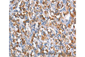 Immunohistochemistry of Human gastric cancer using CD226 Polyclonal Antibody at dilution of 1:60