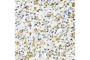 Immunohistochemistry of paraffin-embedded human uterine cancer using HSPA9 antibody (ABIN5970207) at dilution of 1/100 (40x lens).