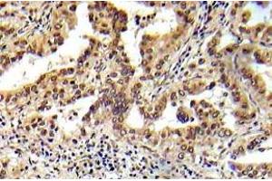 Immunohistochemistry (IHC) analyzes of Tsc2 antibody in paraffin-embedded human prostate carcinoma tissue. (Tuberin anticorps)