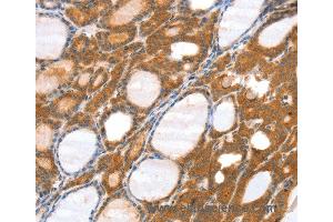 Immunohistochemistry of Human thyroid cancer using SRGAP3 Polyclonal Antibody at dilution of 1:40