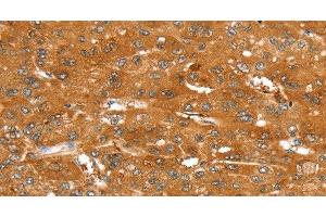 Immunohistochemistry of paraffin-embedded Human liver cancer tissue using ABCC9 Polyclonal Antibody at dilution 1:50 (ABCC9 anticorps)