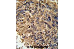 FBXL2 Antibody IHC analysis in formalin fixed and paraffin embedded human lung carcinoma followed by peroxidase conjugation of the secondary antibody and DAB staining. (FBXL2 anticorps  (C-Term))