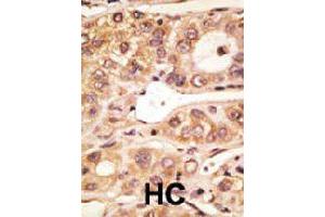 Formalin-fixed and paraffin-embedded human hepatocellular carcinoma tissue reacted with Tlr5 polyclonal antibody  , which was peroxidase-conjugated to the secondary antibody, followed by AEC staining. (TLR5 anticorps  (C-Term))