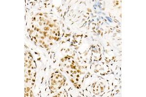 Immunohistochemistry of paraffin-embedded human cervix cancer using Phospho-POLR2A CTD-S5 Rabbit mAb  at dilution of 1:200 (40x lens). (POLR2A/RPB1 anticorps  (pSer5))