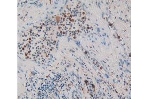 IHC-P analysis of lung cancer tissue, with DAB staining. (NUP153 anticorps  (AA 1238-1468))