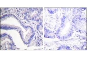 Immunohistochemistry analysis of paraffin-embedded human lung carcinoma tissue, using Caspase 7 (Cleaved-Asp198) Antibody. (Caspase 7 anticorps  (Cleaved-Asp198))