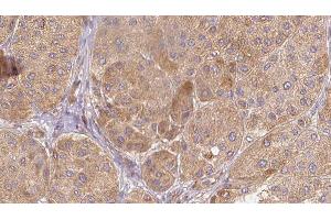 ABIN6277611 at 1/100 staining Human Melanoma tissue by IHC-P. (SEMG1 anticorps  (C-Term))