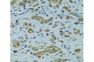 Immunohistochemistry of paraffin-embedded Human gastric cancer using STX1A Polyclonal Antibody at dilution of 1:100 (40x lens). (STX1A anticorps)