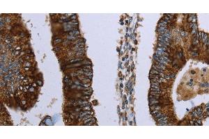 Immunohistochemistry of paraffin-embedded Human colon cancer using HMGCL Polyclonal Antibody at dilution of 1:30 (HMGCL anticorps)