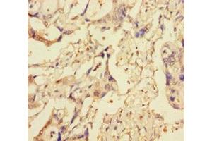 Immunohistochemistry of paraffin-embedded human pancreatic cancer using ABIN7151314 at dilution of 1:100 (XIAP anticorps  (AA 1-497))