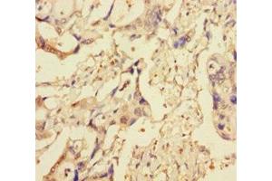 Immunohistochemistry of paraffin-embedded human pancreatic cancer using ABIN7151314 at dilution of 1:100