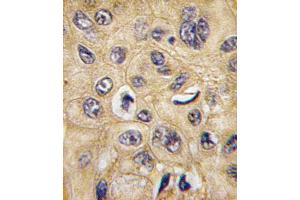 Formalin-fixed and paraffin-embedded human hepatocarcinoma tissue reacted with TSC2 Antibody  (ABIN390324 and ABIN2840755) , which was peroxidase-conjugated to the secondary antibody, followed by DAB staining. (Tuberin anticorps  (AA 1776-1805))